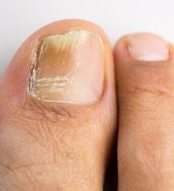 Гъбички на ноктите на големия пръст на крака, които се появяват на фона на слаб имунитет