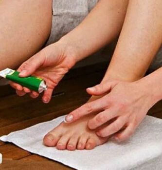 Използването на терапевтичен мехлем за поражение на нокътя на големия пръст на крака с гъбички