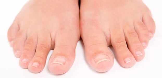 Пръстите на краката с гъбички по ноктите