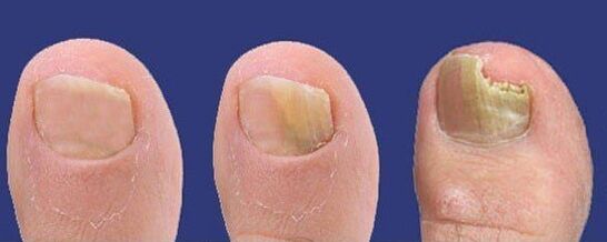 Развитие на гъбички по ноктите на краката