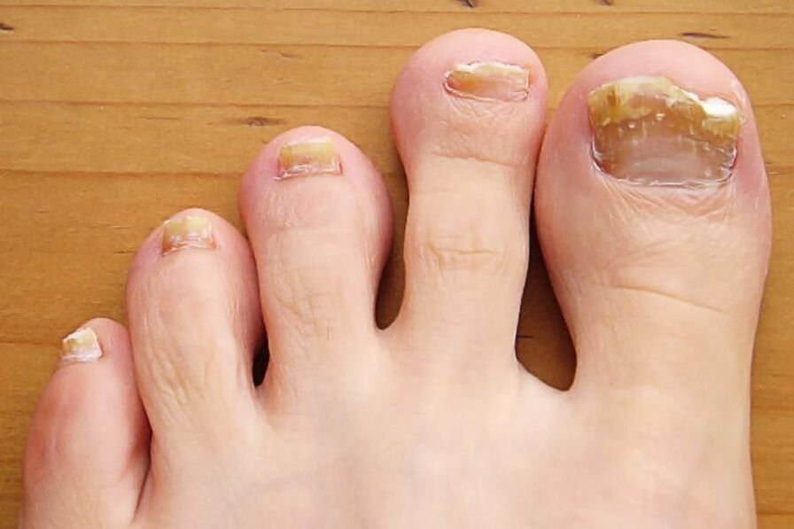симптоми на гъбички по ноктите