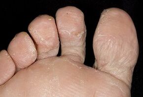 Кожата на краката с гъбична инфекция