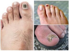 Признаци на гъбична инфекция на ноктите на краката