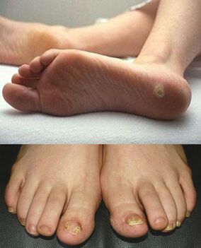 Прояви на микоза по кожата и ноктите на краката