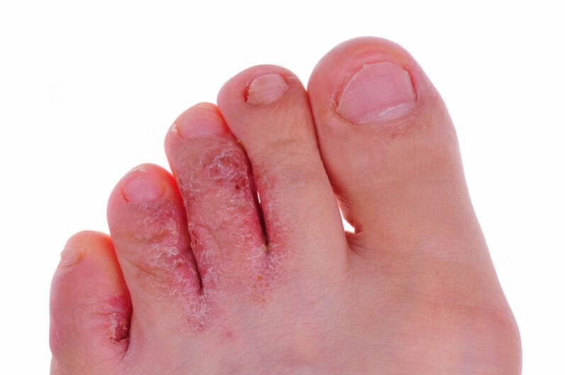 Симптоми на руброфитоза - пукнатини и люспи по кожата на краката