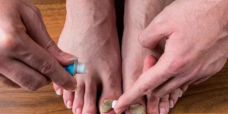 причини за гъбички между пръстите на краката