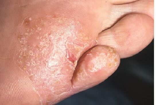 Прояви на гъбична инфекция по кожата на краката