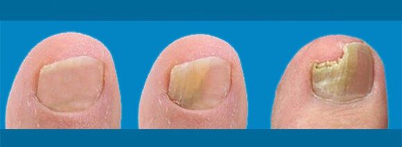 Развитието на онихомикоза - гъбички по ноктите на краката